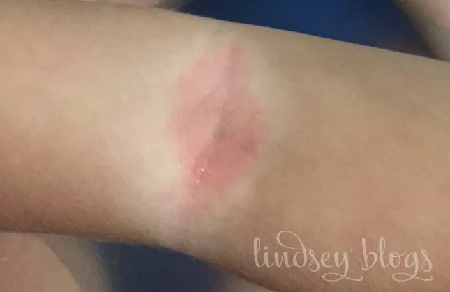 Mild Eczema in Elbow